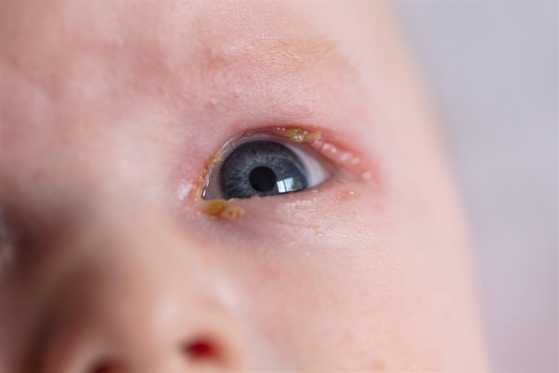 التهاب عين الرضيع